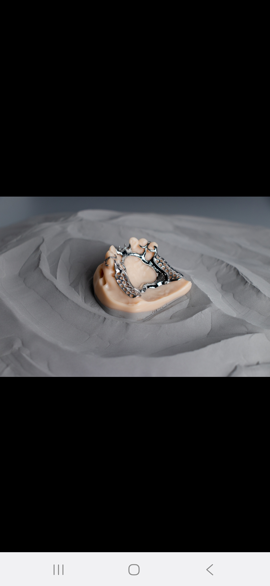 보철 프레임워크 - 치과 모델 위 메탈 프레임